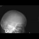 Fissure of the skull, pneumocephalus: X-ray - Plain radiograph